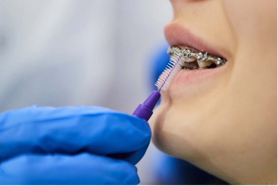 person having braces and tetth cleaned with special brush