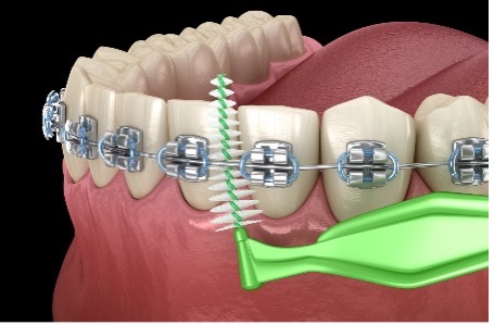 A picture showing an Interproximal brush